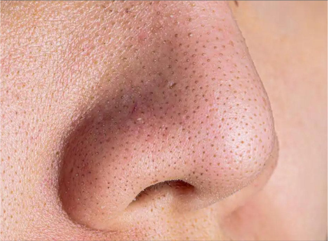 ¿Cómo quitar los puntos negros del rostro? Sigue estos consejos